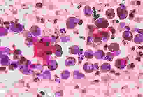 الأميبا الآكلة للدماغ الأميبا الآكلة للدماغ